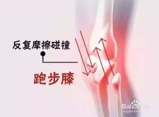 跑步膝盖疼多久能恢复：三点膝关节炎的常识