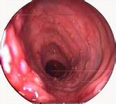 十二指肠溃疡四大危害