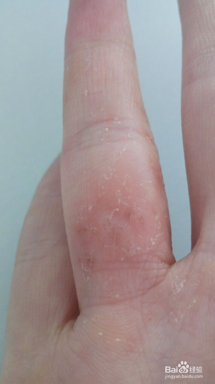 手指小水泡的治疗过程（真实经验）