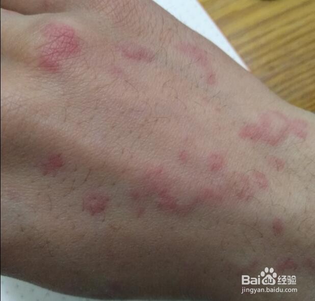 打破伤风一周后过敏怎么办？