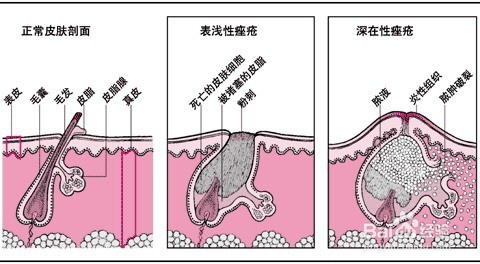 胸前长痘痘的原因