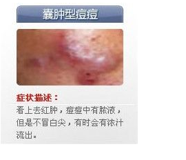 世上最全面治疗痘痘大全