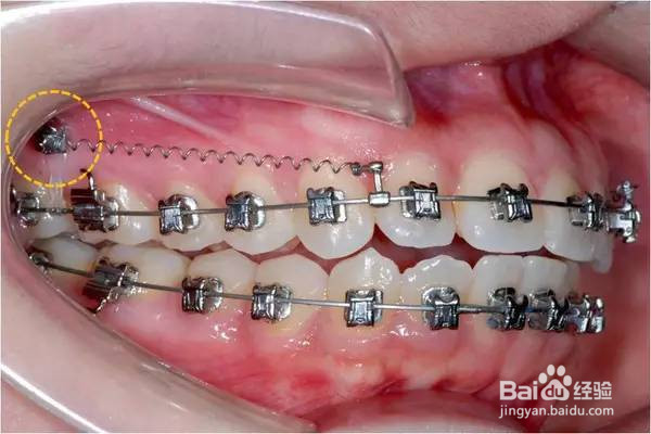 牙齿矫正的骨钉是什么？