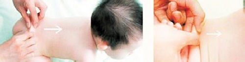 小儿捏脊疗法