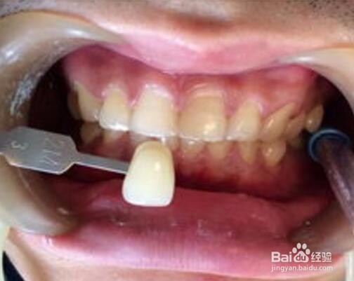 为什么牙齿怎么刷都不白