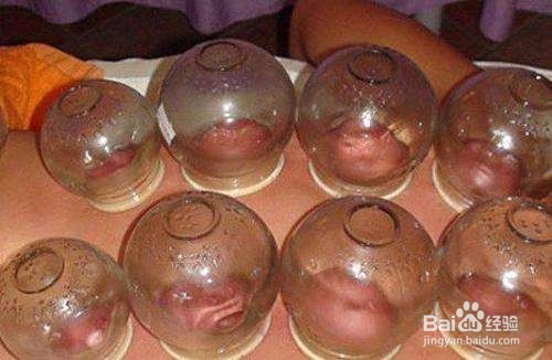 拔罐有什么讲究吗？