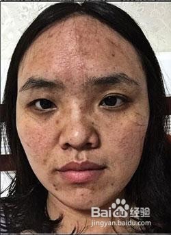 脸上有逗逗印怎么消除