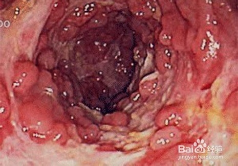 克罗恩病在临床上一般有哪些常见表现？