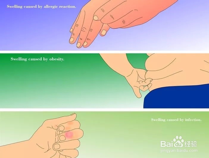 怎样减轻手指肿胀?