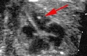 孕检出现唐筛高危、肾盂增宽异常等情况怎么办？