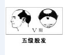 男性流花植发有哪些优点和特点?