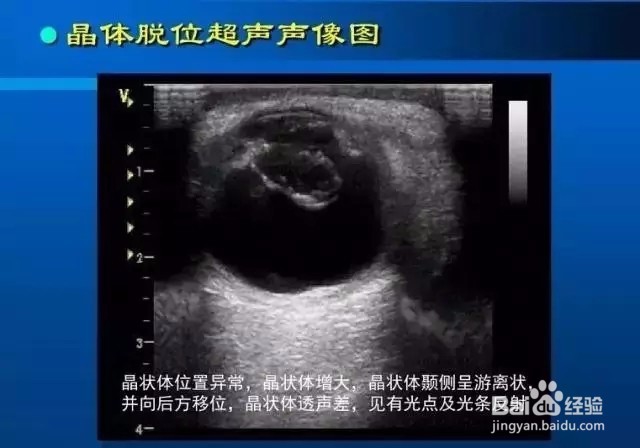 几种常见眼病B超图谱及诊断