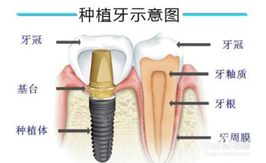 牙齿缺失怎么修复