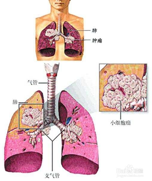 肺癌的鉴别诊断,如何去诊断