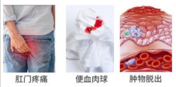 痔疮如何避免开刀