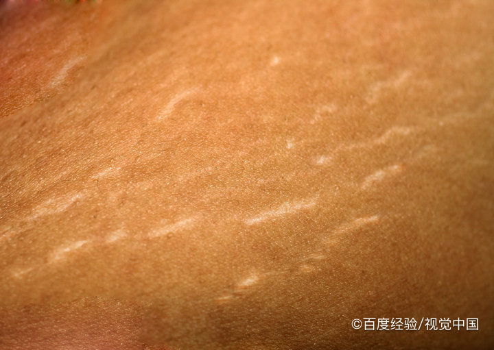 产生妊娠纹后，怎样才能将它消除？