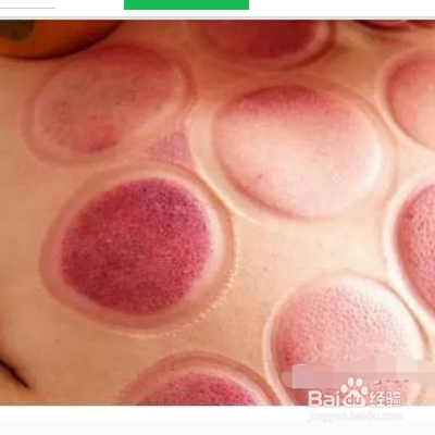 拔罐祛湿吗,拔罐祛湿效果好吗？