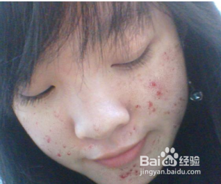 脸上痘痘怎么样快速消除(方法超实用)