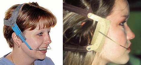 牙齿矫正的骨钉是什么？