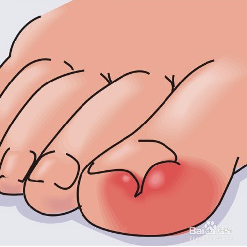 脚趾甲长进肉里了怎么办？？