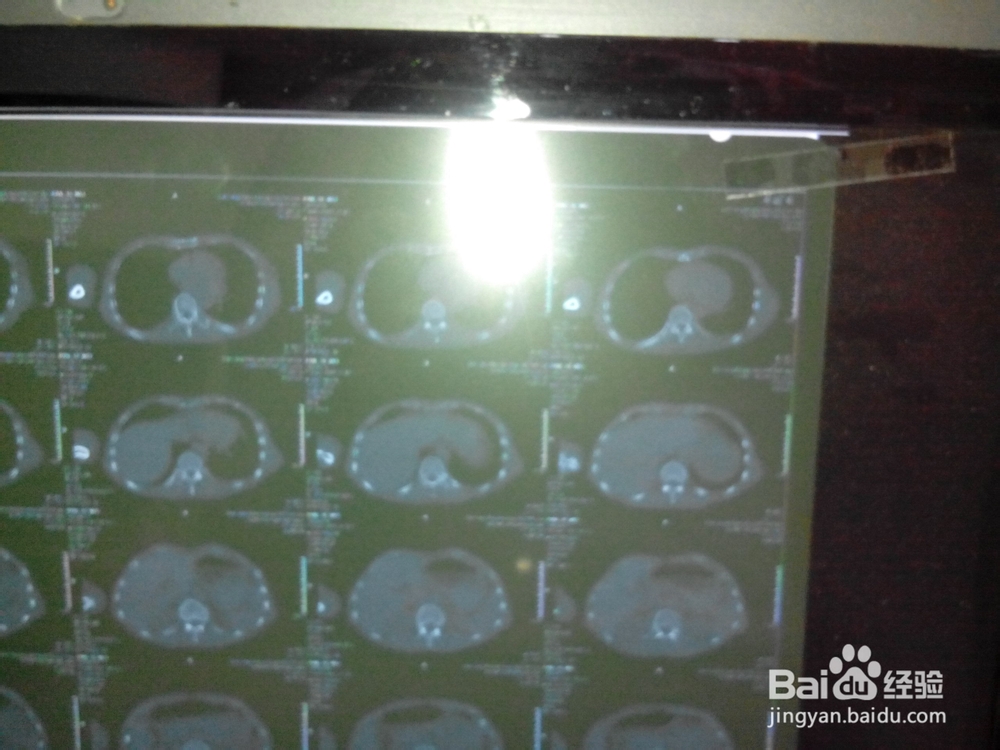 拍摄医院CT，X光片技巧