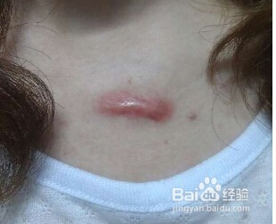 整形术后会不会有疤痕？