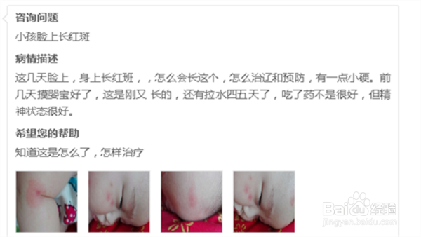 宝宝身上出现红斑及腹泻等症状，见于什么病？