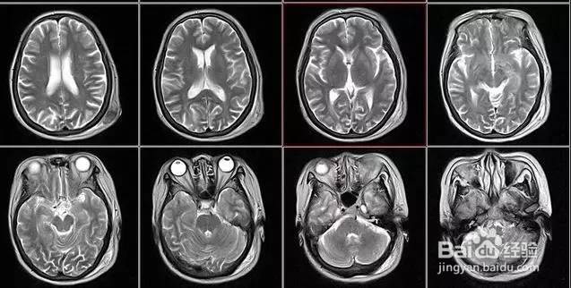 如何识别B超、X线、CT、核磁的共振的不同用途