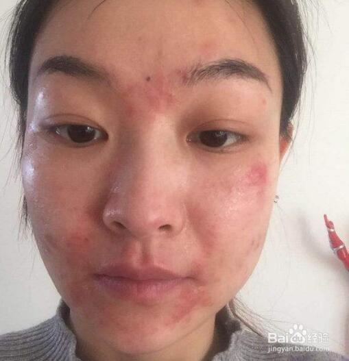 激素脸和过敏脸如何区分,怎么治疗