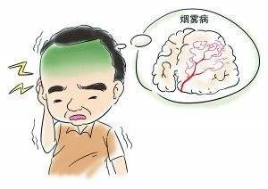 先天性烟雾病可以保守治疗吗