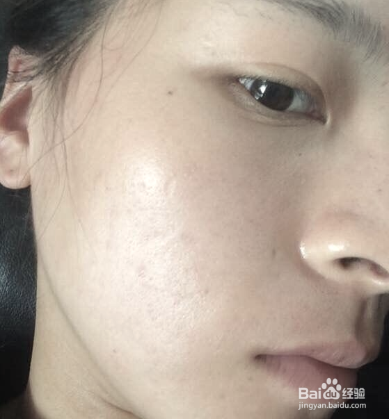 如何祛痘和痘印？