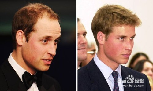 明星也愁发际线 如何拯救男同胞们的头发