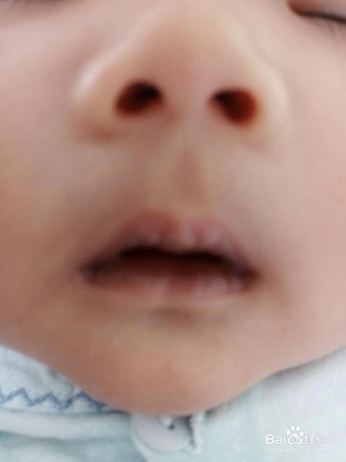 宝宝满月了脸还有点黄怎么办