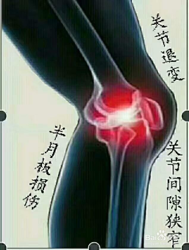 中医如何治疗髌骨软化症
