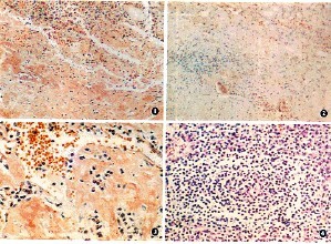 强直性脊椎炎的症状与治疗办法