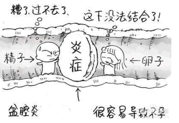 盆腔炎有哪些症状?怎么检查?