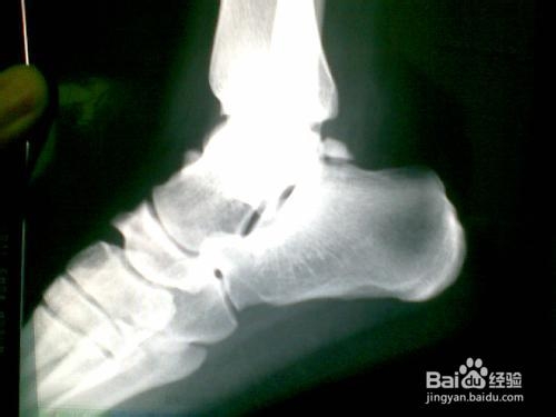 脚扭伤了怎样尽快恢复