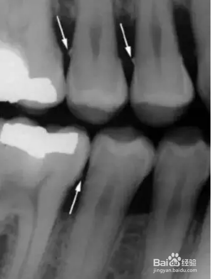优梨美牙的牙周检查内容