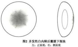 什么是白内障?引起白内障又有哪些原因?