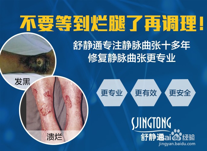 静脉曲张不治疗有哪些危害，详细阅读