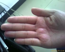 手上起皮是怎么回事