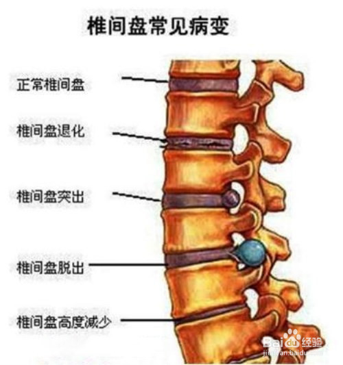 腰痛的运动缓解及腰椎间盘突出的预防