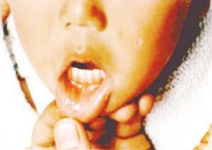 宝宝得了手足口病（轻型），宝妈处理经验