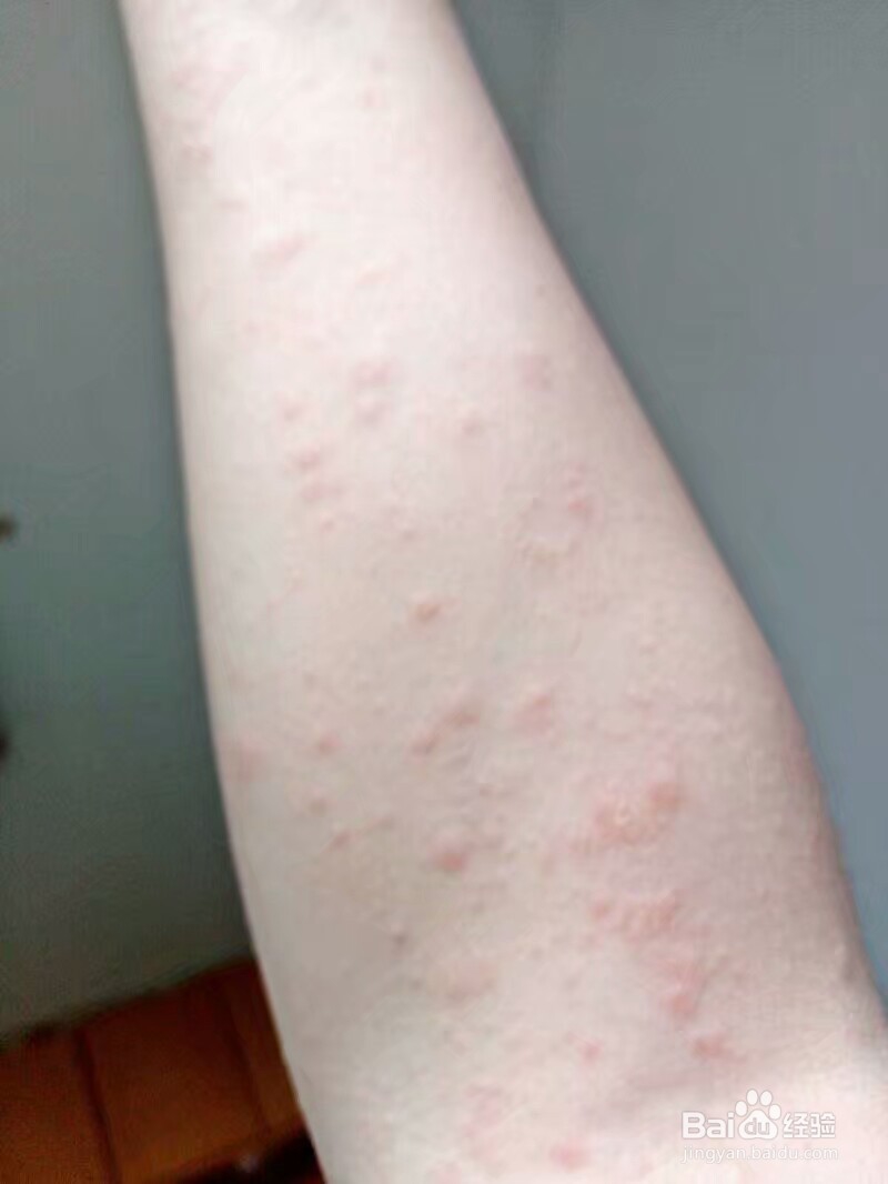 不吃药治疗玫瑰糠疹的正确方法