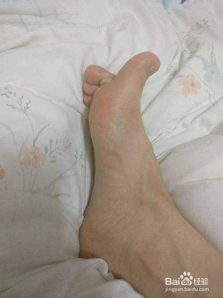 冬季脚裂口是什么原因