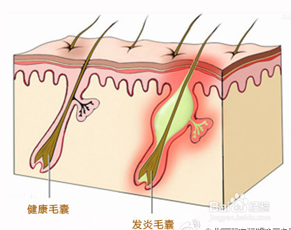 如何预防青春痘它是什么形成的