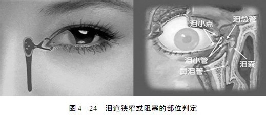 经常流眼泪的原因与治疗