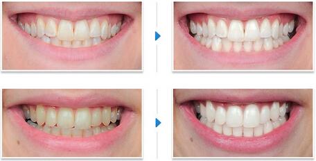 小苏打加盐可以去除牙黄.