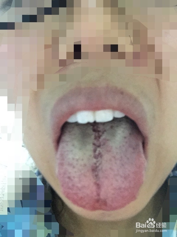 舌苔厚白是怎么回事?