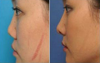 什么去痘印管用?分清类型有效祛痘印